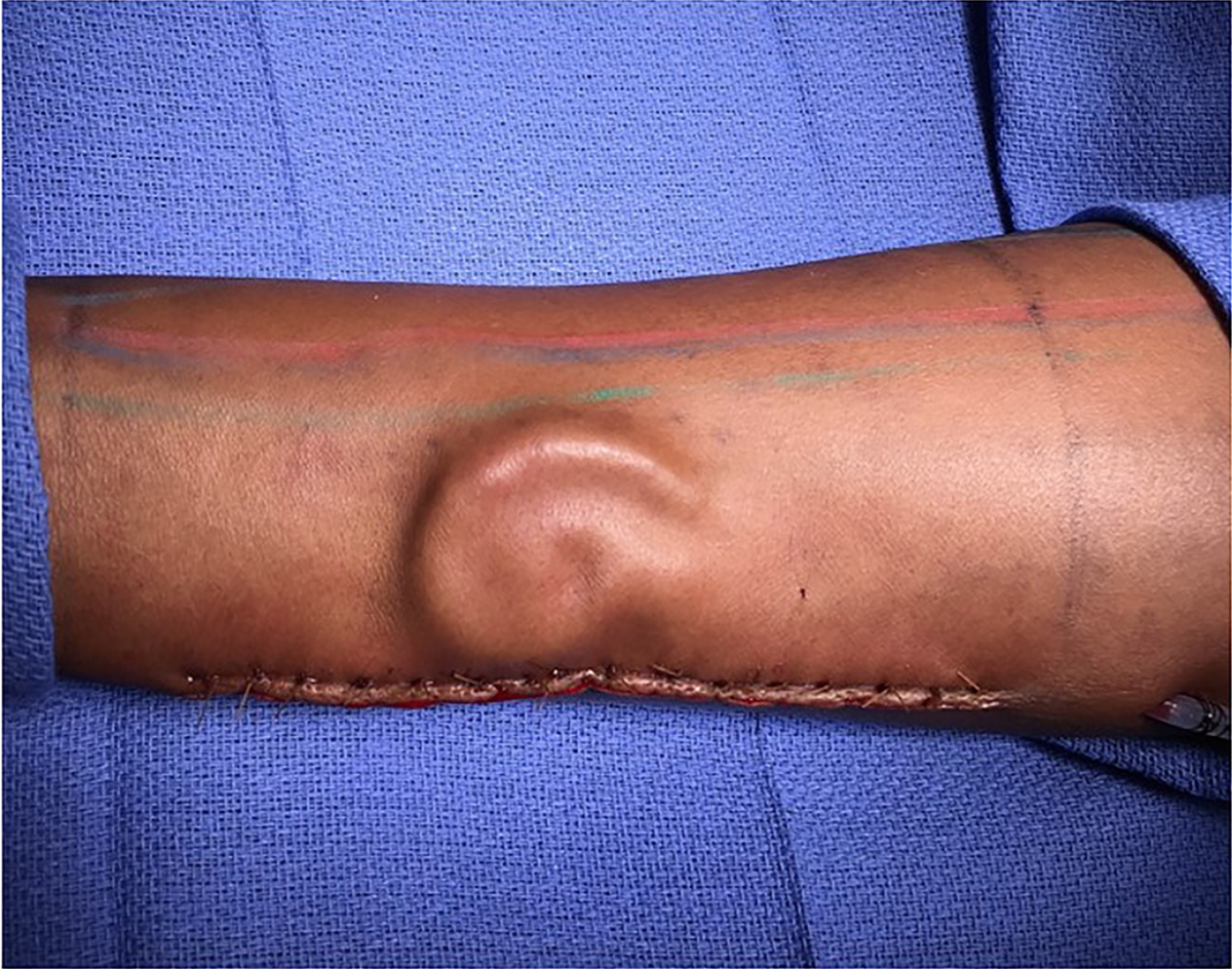 How Did This Soldier 'Grow' an Ear on Her Forearm?